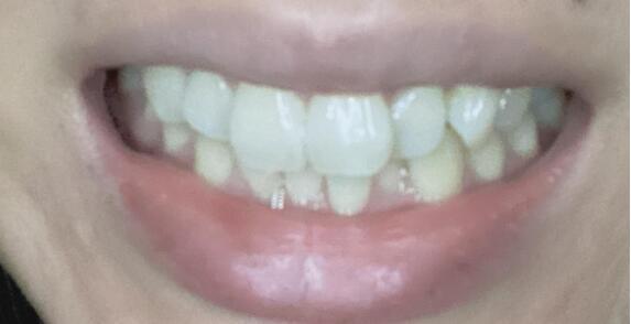 30幾40歲先走去cool箍牙過程分享屯門篇 U Blog