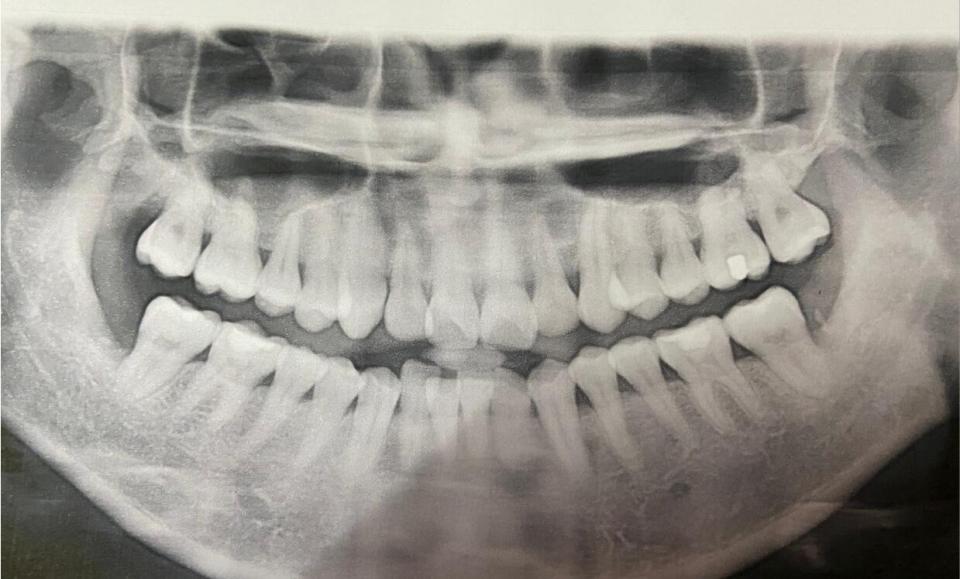 箍牙前準備 Xray 影相 印模 洗牙 預約剝牙 U Blog