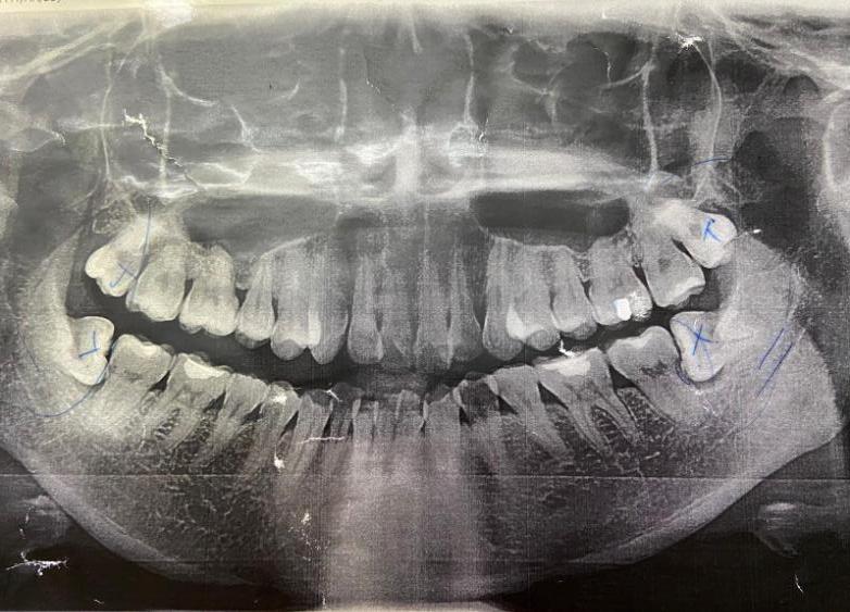 箍牙前準備 Xray 影相 印模 洗牙 預約剝牙 U Blog