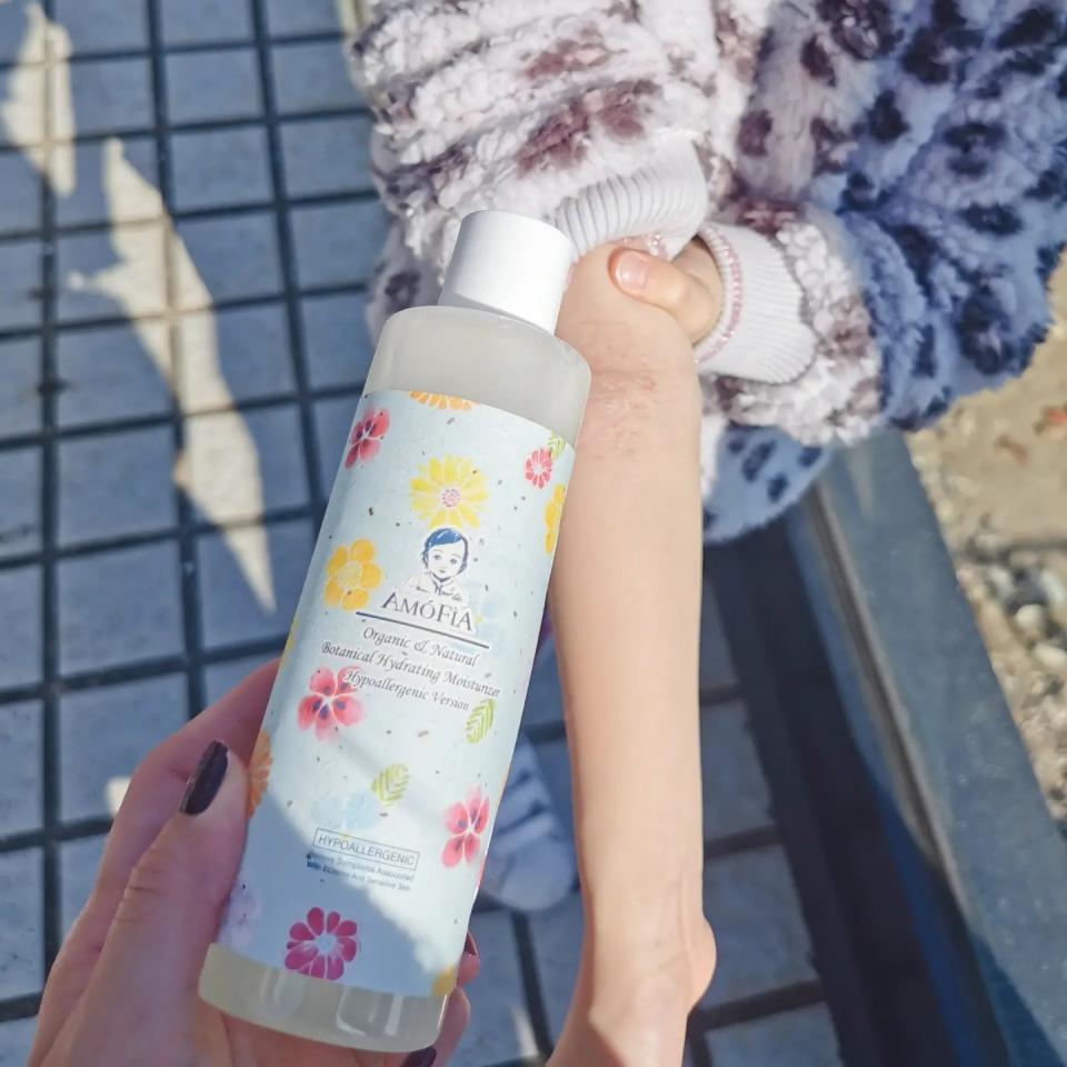 濕疹嬰幼兒情況: Bella 妹妹用我地保濕水同濕疹膏後有改善濕疹情況