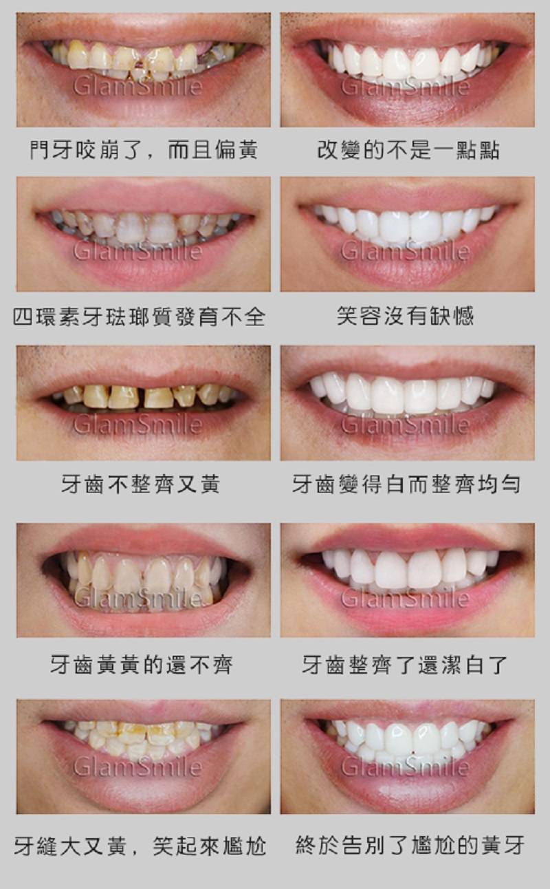 立即拆解5個全瓷美白牙齒貼片的疑惑解決牙黃無煩惱- U Blog
