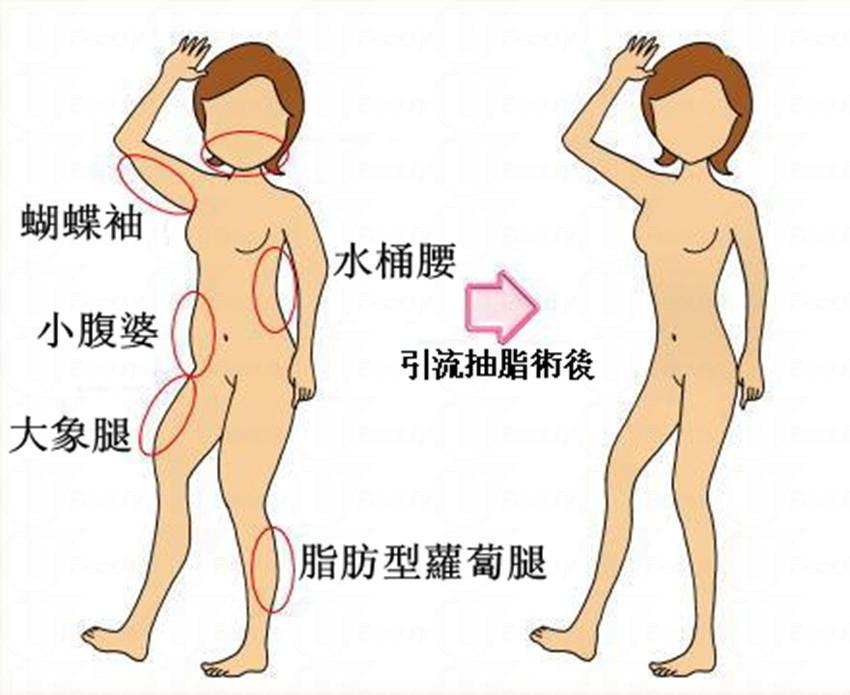 「抽脂」不等於減肥 「抽脂」不等於減肥