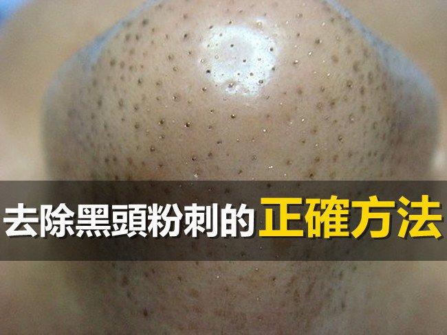 清理黑頭有妙法天然又有效
