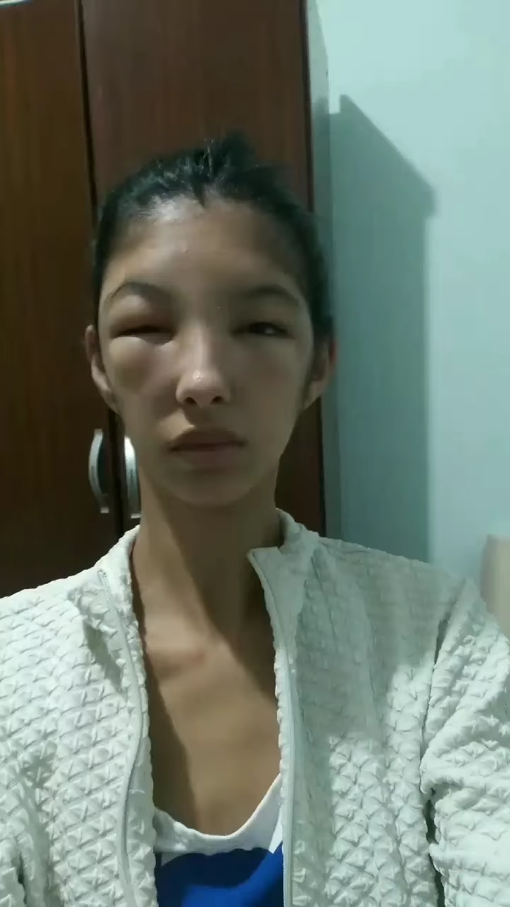 19歲網紅DIY染髮嚴重過敏變「豬頭」 ！頭皮滲液一隻眼睛睜不開！告誡染頭前必做1件事！