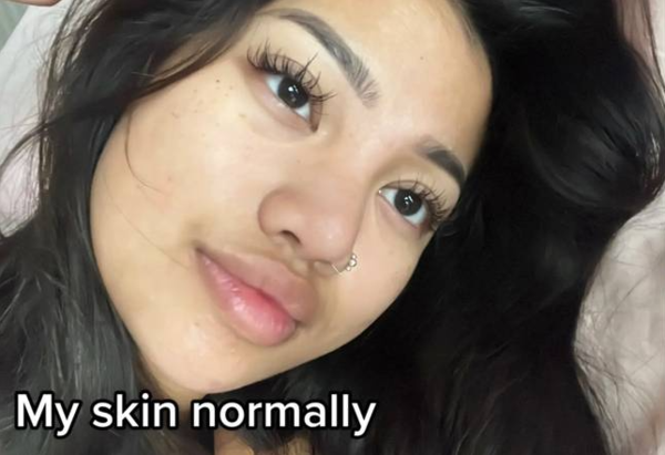 閨蜜共用化妝掃後爛面毀容！臉部佈滿圓形癬！含菌量超「廁所板」可致膿痂疹！