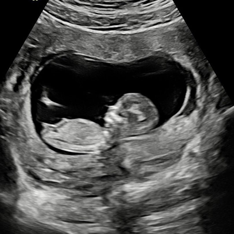 鍾欣潼前夫賴弘國大晒超聲波照片！宣佈再成為爸爸兩年抱兩！