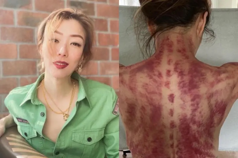 刮痧能減重/改善水腫/橘皮？鄭秀文：刮走濕氣爽到爆【附中醫意見】