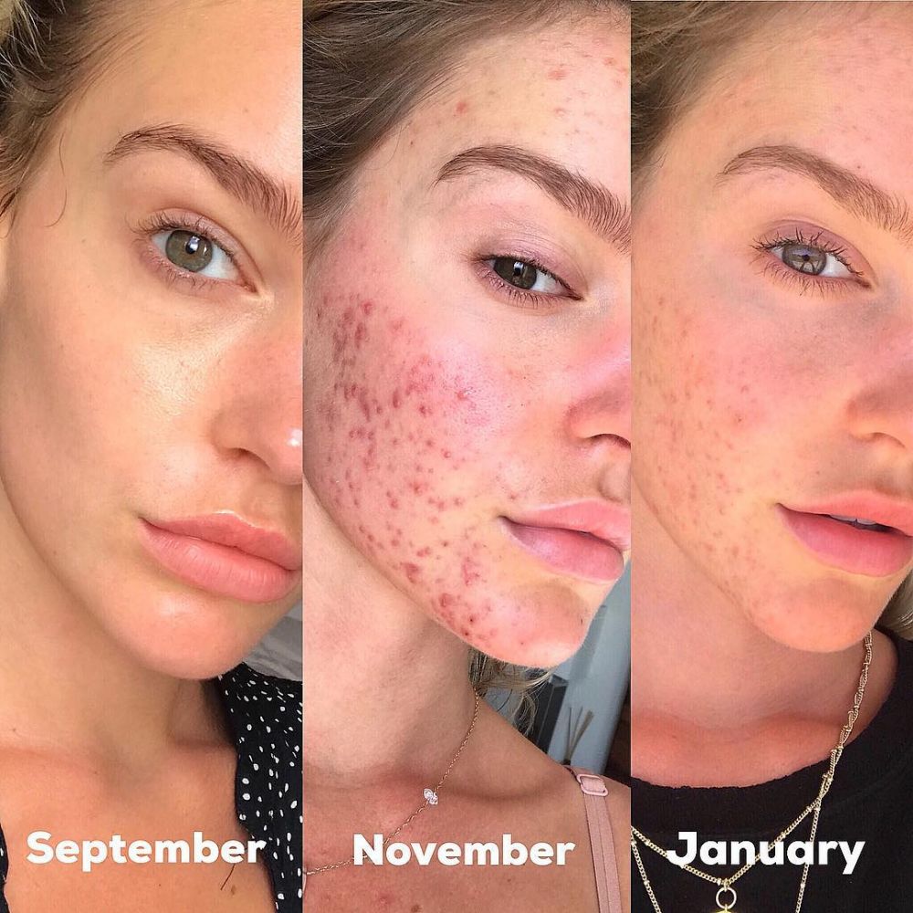 【內附註冊中醫師意見】4個月由「痘痘肌」變成「白滑肌」？澳洲模特兒靠3招拯救暗瘡爛面！