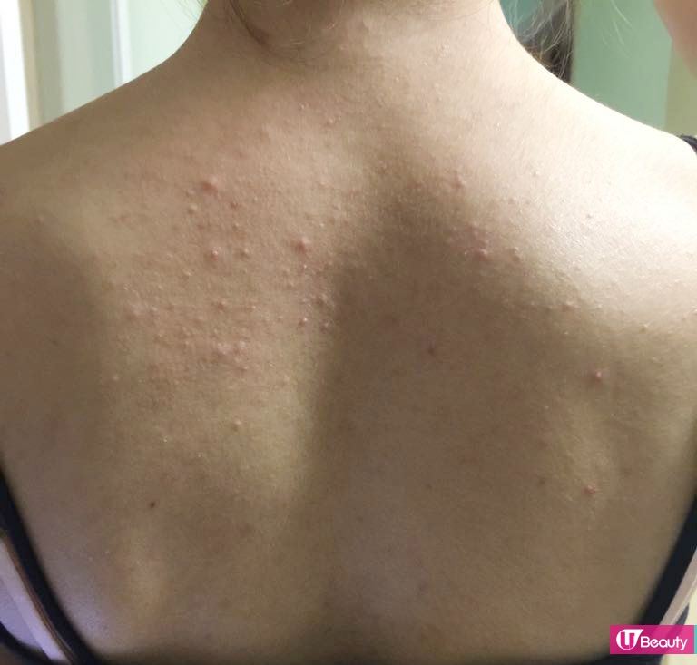 【Viphy週記】阿Vi 10年改善背部暗瘡之路！8個還原白滑美背方法！(附消背痘產品推介)