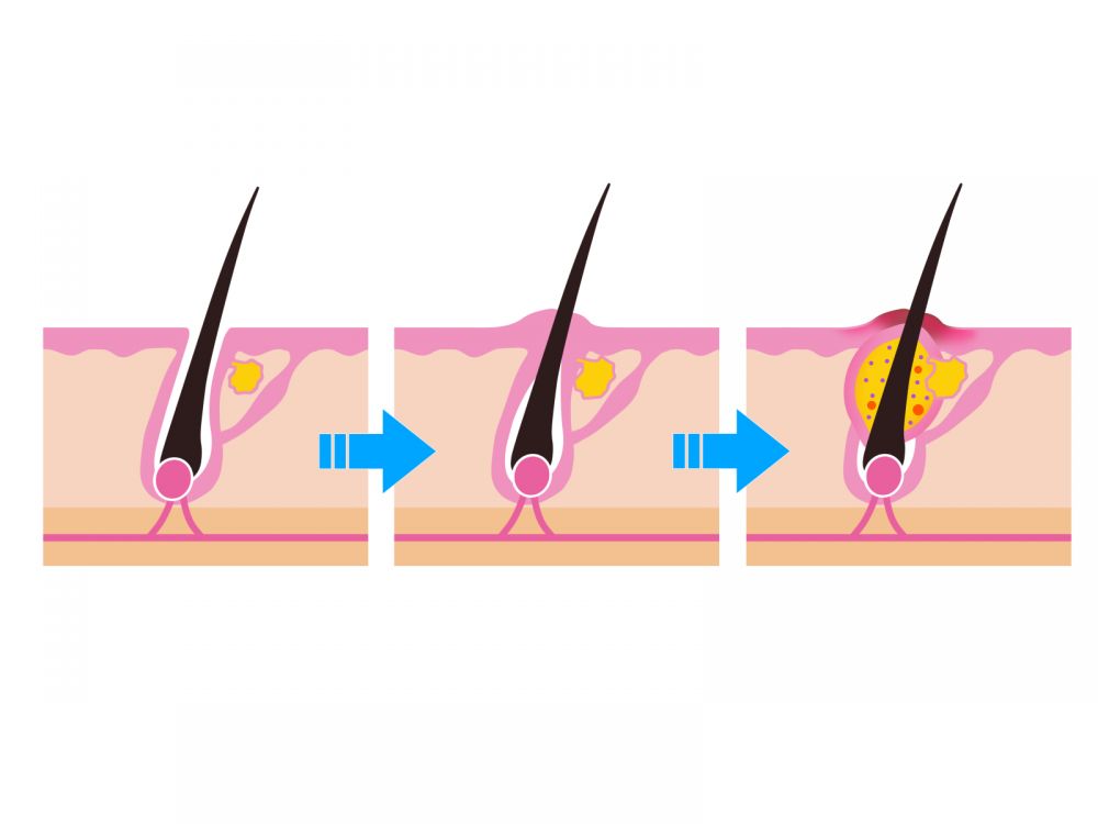 約會前生暗瘡點算好？美容專家教你2個快速代謝暗瘡/粉刺技巧！