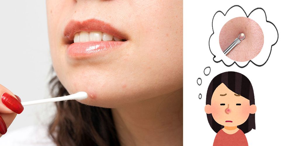 美容治療師傳授8大暗瘡肌護膚要訣！暗瘡肌適合針清？黑頭針擠壓易致毛孔粗大！