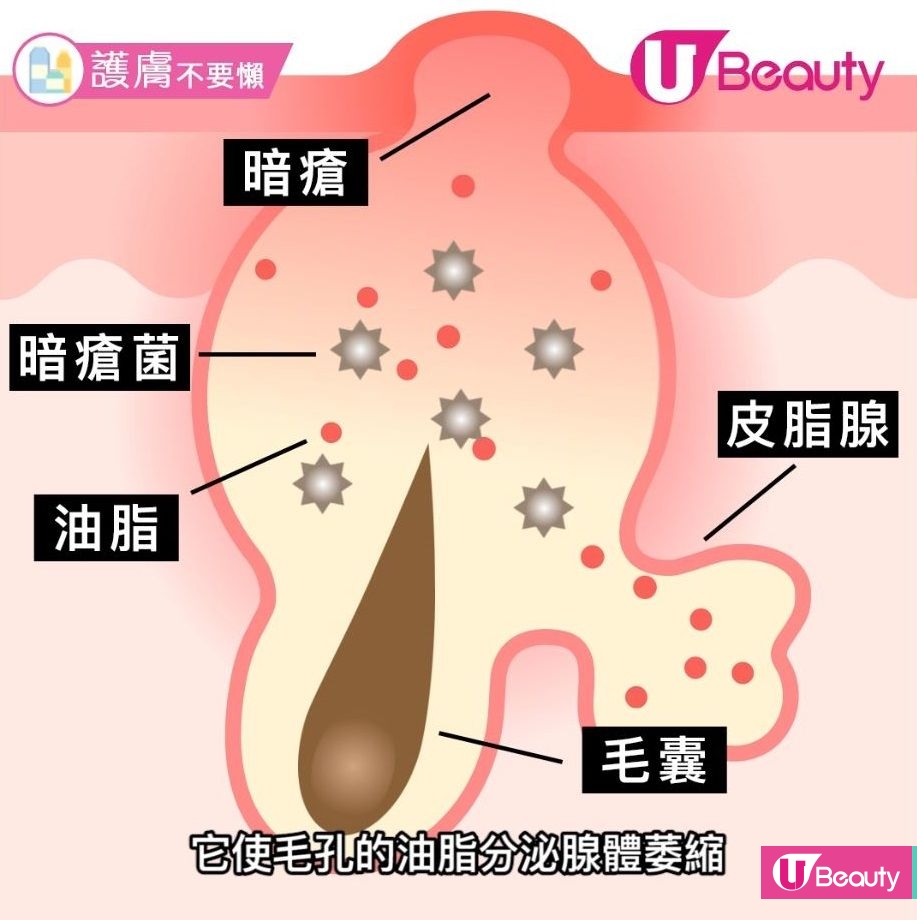 【A酸懶人包】一文解答A酸原理、爆發期、副作用！皮膚科醫生：治療暗瘡特效藥