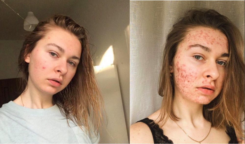 22歲烏克蘭少女移民後滿臉暗瘡！全臉紅腫流血！醫師：可能是「這個」作怪！