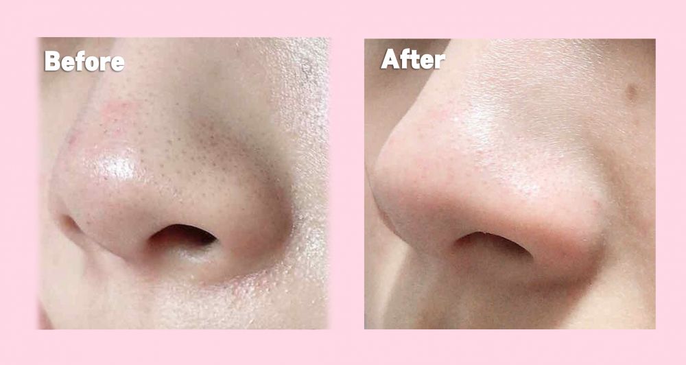 日本女生好評「去黑頭神器」！竟是MUJI平價護膚好物？頑固黑頭粉刺浮出！