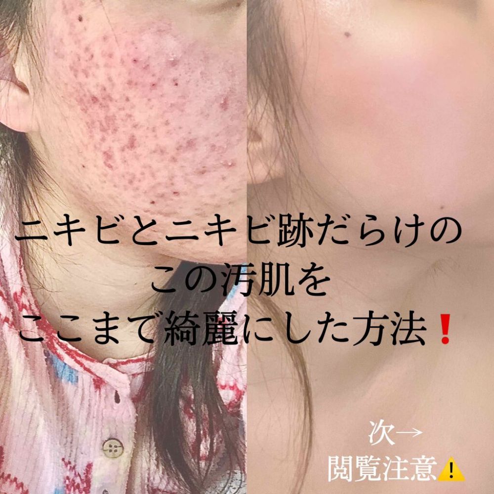 去暗瘡｜日本女生分享治療暗瘡/去印經驗！改掉「這些」壞習慣！推薦3款開架護膚品！