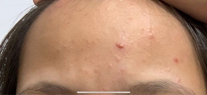 台灣女生分享「去粉刺保養記」！2個月改善粉刺問題！從飲食習慣、護膚品入手！