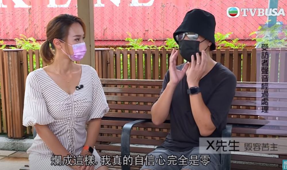 激光去凹凸洞療程失敗個案分享！男事主全臉燒傷+發炎含膿！一文看清皮秒激光+CO2激光！