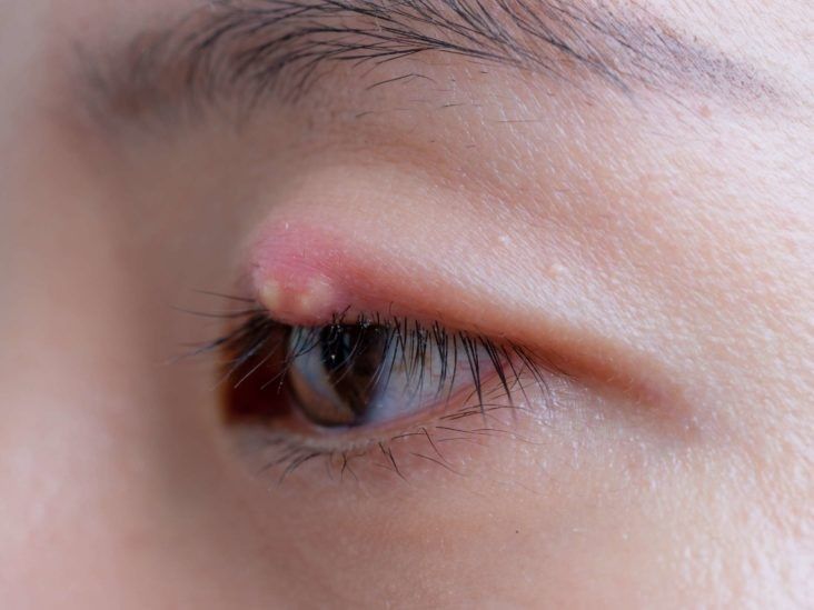 【眼挑針】眼科醫生拆解眼挑針成因！用雞蛋/毛巾熱敷？能夠自行處理？