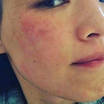 10款濕疹藥膏推介(部分香港有售)！無類固醇配方BB適用！止痕/紓緩紅腫/抗菌功效！