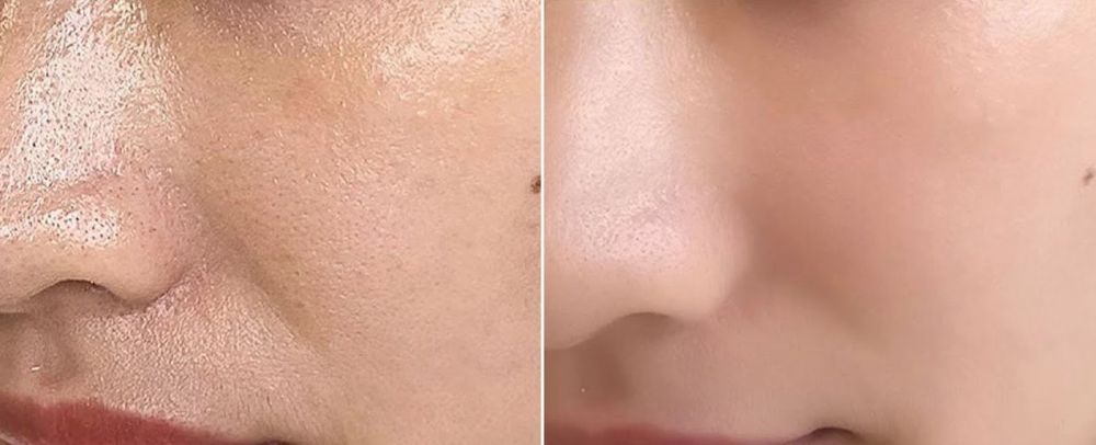 日本美容師分享3招告別滿臉油光！不能過度洗臉？油性肌女生必看！