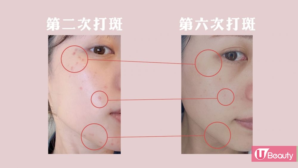 【醫美心得】萬元療程值得嗎？激光去斑的真實用家！親身分享+術後護理心得！詳細解說打斑的一二事！