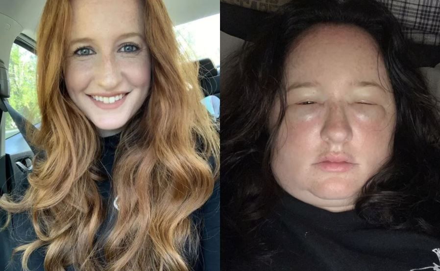 美國女生染髮後過敏臉腫到變形！嚴重化學灼傷！皮膚刺痛狂冒水泡/疹子！