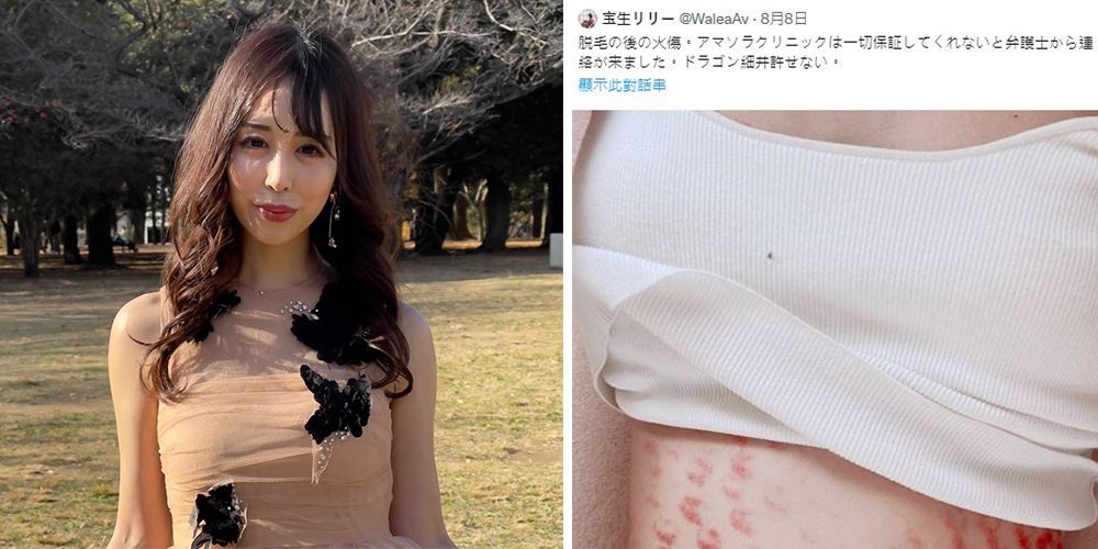 日本女優一花琴音激光脫毛後燒傷！滿身傷痕兼起水泡！恐怖密集傷口照曝光！