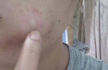 23歲女亂擠暗瘡導致臉部感染！半邊臉腫脹要縫6針！美容治療師教8大暗瘡護理方法！