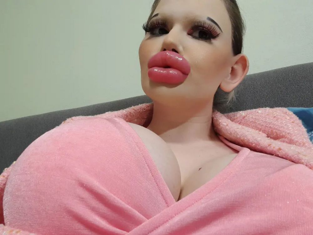 24歲女嘴唇注射30次變「孖膶腸」！整容上癮連進食都有困難！醫生警告：有機會致命！