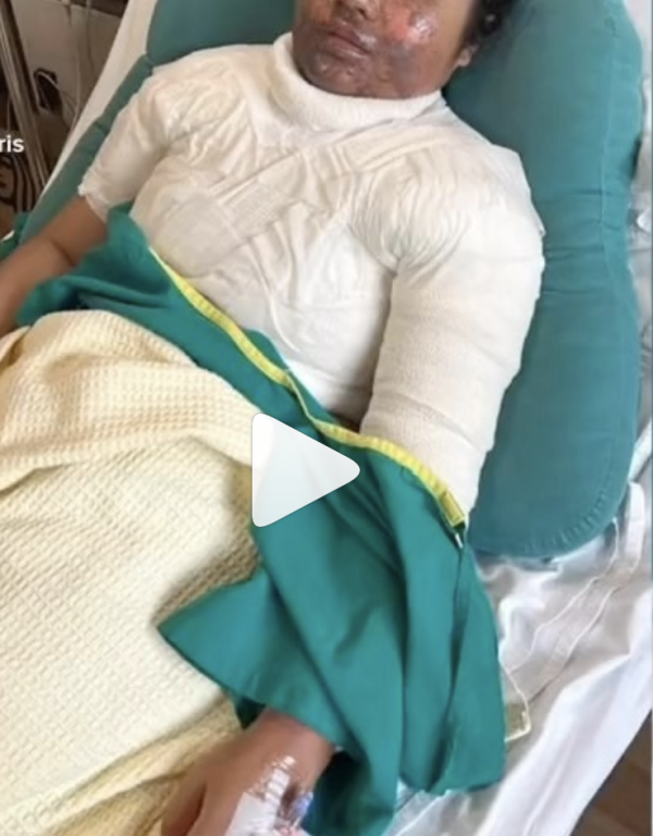 高壓煲蒸氣未釋放突爆炸 女子遭滾湯濺致二級灼傷