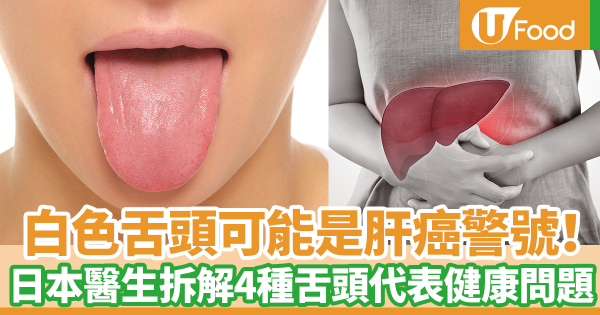有白色舌頭可能是肝癌警號! 日本醫生拆解4種舌頭代表健康問題