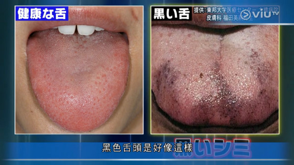 有白色舌頭可能是肝癌警號! 日本醫生拆解4種舌頭代表健康問題
