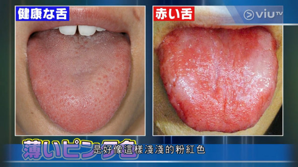 有白色舌頭可能是肝癌警號! 日本醫生拆解4種舌頭代表健康問題