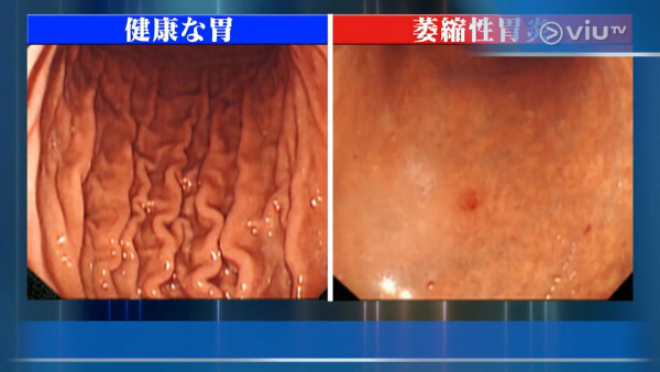 有白色舌頭可能是肝癌警號！　日本醫生拆解4種舌頭代表健康問題