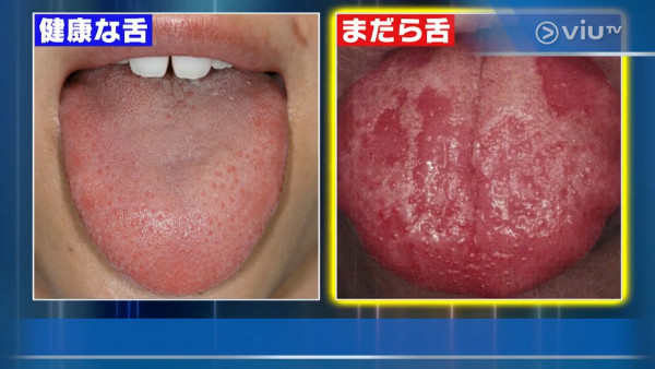 有白色舌頭可能是肝癌警號! 日本醫生拆解4種舌頭代表健康問題