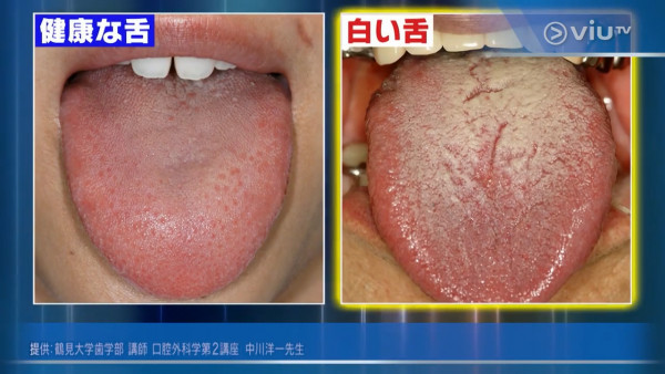 有白色舌頭可能是肝癌警號！　日本醫生拆解4種舌頭代表健康問題