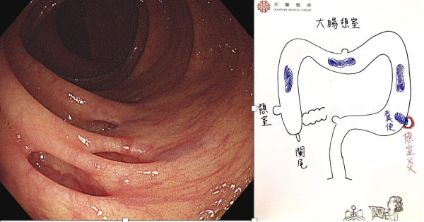 如廁玩手機小心大腸變洞洞 易卡糞便致發炎／醫生教6招預防大腸憩室