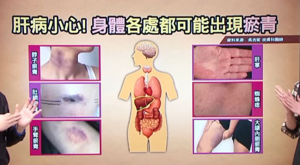 皮膚出現這3情況恐肝功能差！ 醫生解釋原因／護肝食譜推介