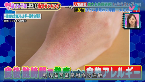 常吃一種水果導致患上嚴重主婦手！　醫生：即使沒有對水果敏感也可以引起過敏反應