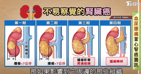 28歲女電競教練腎癌病逝 6大壞習慣促患癌／勸粉絲「不要像我一樣」