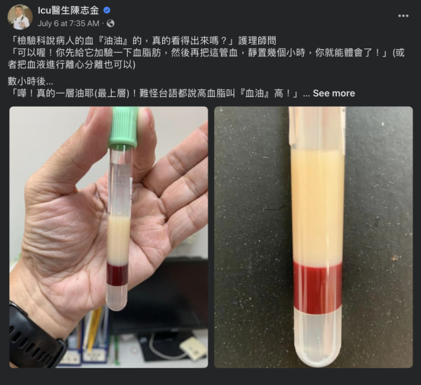 三酸甘油酯超標10倍！抽血抽出「豬肉凍」　醫生警告恐引發胰臟炎