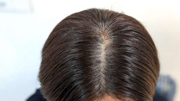 曬太陽會出白頭髮及禿頭？ 日本專家教你4個預防方法