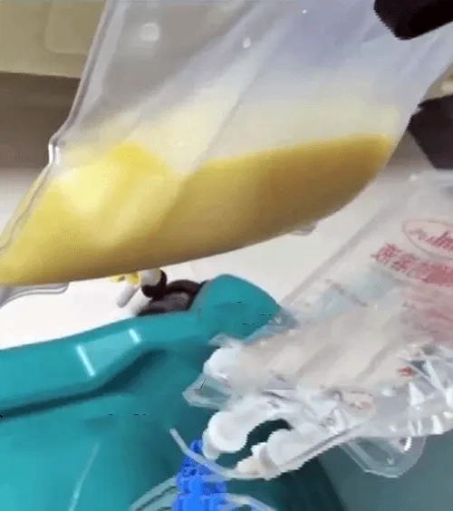 14歲女童抽出2公升「白色血液」求醫揭因零食當正餐致胰臟炎高血脂症