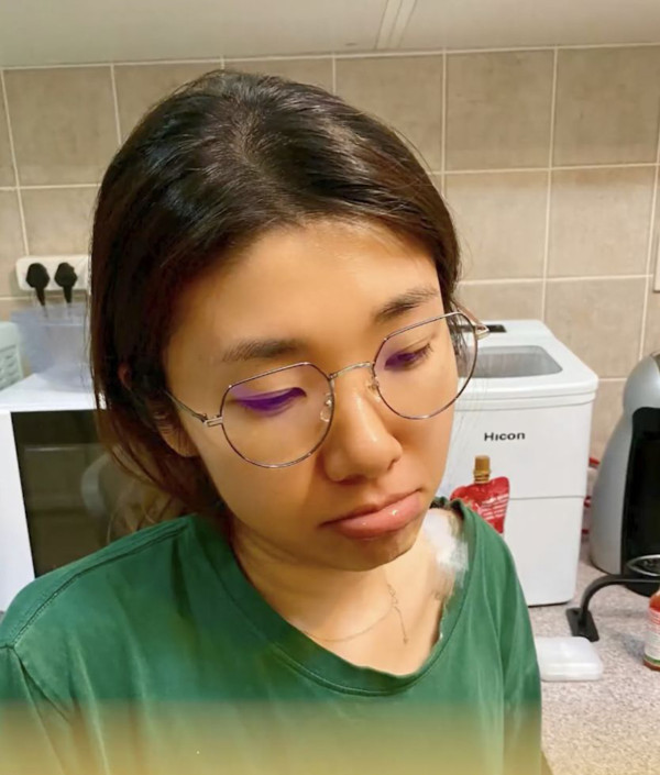 為減肥連食三個月紅蘿蔔 女子皮膚變色慘成「橙色人」