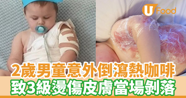 2歲男童意外倒瀉熱咖啡 致3級燙傷皮膚當場剝落