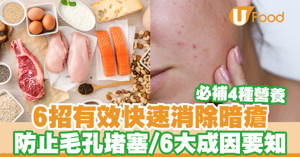 6招有效快速消除暗瘡 防止毛孔堵塞／6大生暗瘡成因