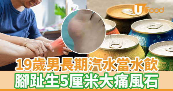 19歲男長期汽水當水飲 腳趾生5厘米大痛風石