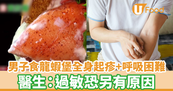 男子食龍蝦堡全身起疹兼呼吸困難 醫生：過敏恐另有原因