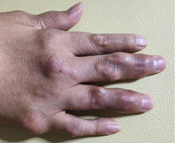 32歲男一個飲食習慣 手指關節生滿痛風石