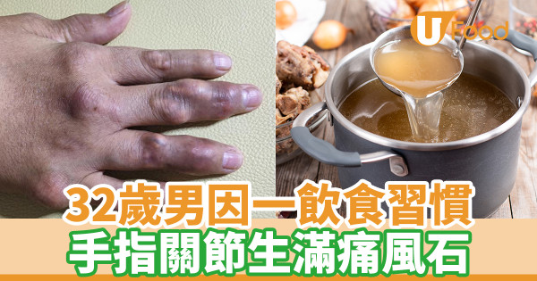 32歲男一個飲食習慣 手指關節生滿痛風石